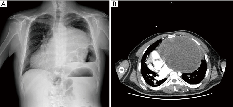 An asymptomatic giant AB thymoma in a patient with Down syndrome: a case report.