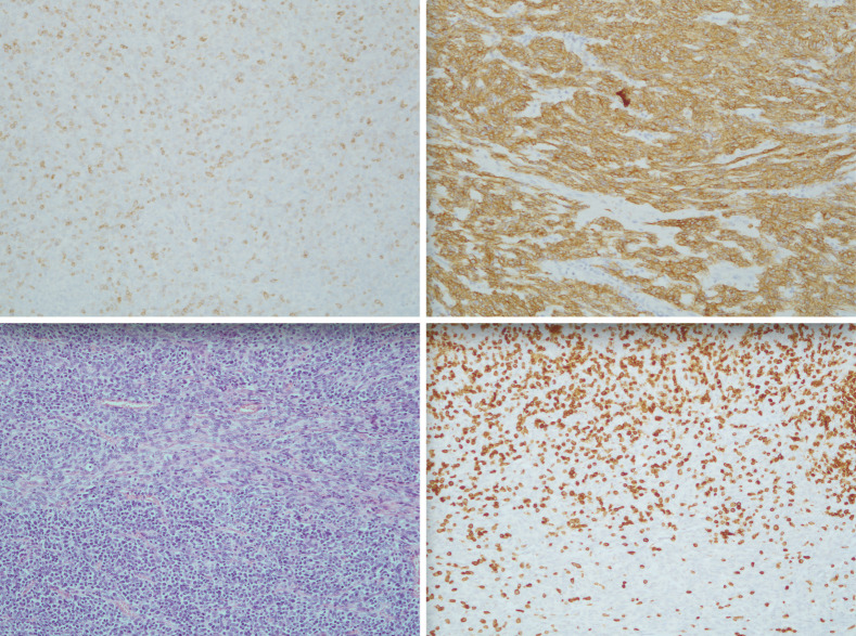 An asymptomatic giant AB thymoma in a patient with Down syndrome: a case report.