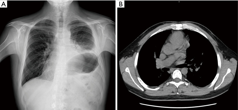 An asymptomatic giant AB thymoma in a patient with Down syndrome: a case report.