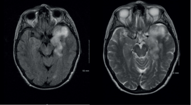 STROKE, COVID-19 INFECTION OR HERPES SIMPLEX ENCEPHALITIS: A DIAGNOSTIC DILEMMA.