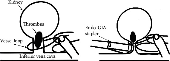 Novel Technique for Hand-Assisted Laparoscopic Nephrectomy for Advanced Renal Cell Carcinoma with Renal Vein and Inferior Vena Cava Thrombi: Three Case Reports.