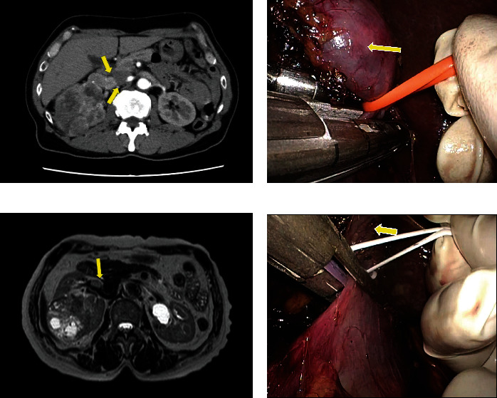 Novel Technique for Hand-Assisted Laparoscopic Nephrectomy for Advanced Renal Cell Carcinoma with Renal Vein and Inferior Vena Cava Thrombi: Three Case Reports.