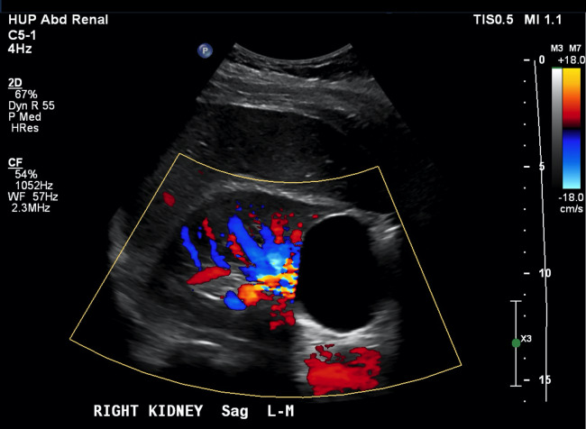 Incidentalomas Among Healthy Nephrology Fellow Volunteers at POCUS Workshops: A Case Series.