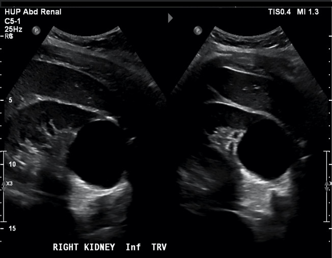 Incidentalomas Among Healthy Nephrology Fellow Volunteers at POCUS Workshops: A Case Series.