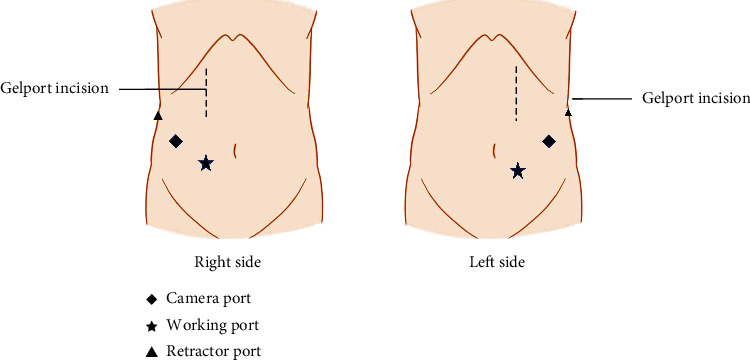 Novel Technique for Hand-Assisted Laparoscopic Nephrectomy for Advanced Renal Cell Carcinoma with Renal Vein and Inferior Vena Cava Thrombi: Three Case Reports.