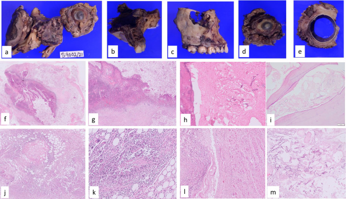 Pathogenesis and Pathology of COVID-Associated Mucormycosis: What Is New and Why.