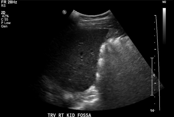 Incidentalomas Among Healthy Nephrology Fellow Volunteers at POCUS Workshops: A Case Series.