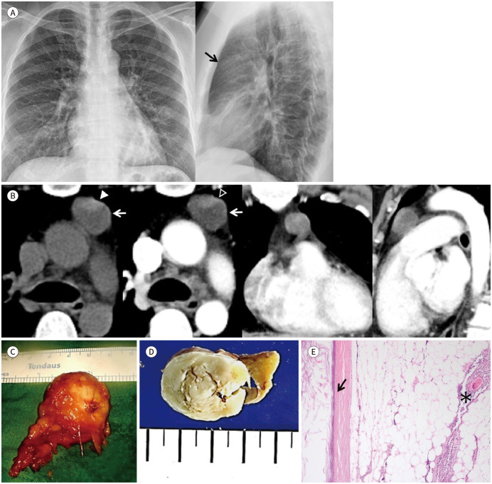 CT Findings of Thymic Epidermoid Cyst in the Anterior Mediastinum: A Case Report and Literature Review.