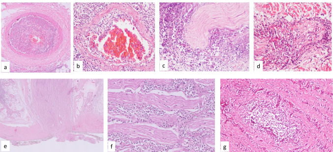 Pathogenesis and Pathology of COVID-Associated Mucormycosis: What Is New and Why.