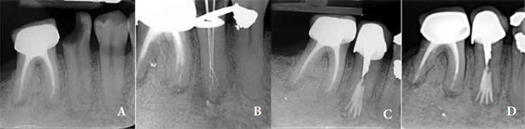 Mandibular Second Premolar with Four Canals: A Case Report.