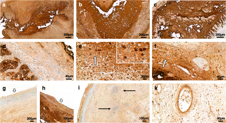 DMBT1 expression and neutrophil-to-lymphocyte ratio during necrotizing enterocolitis are influenced by impaired perfusion due to cardiac anomalies.