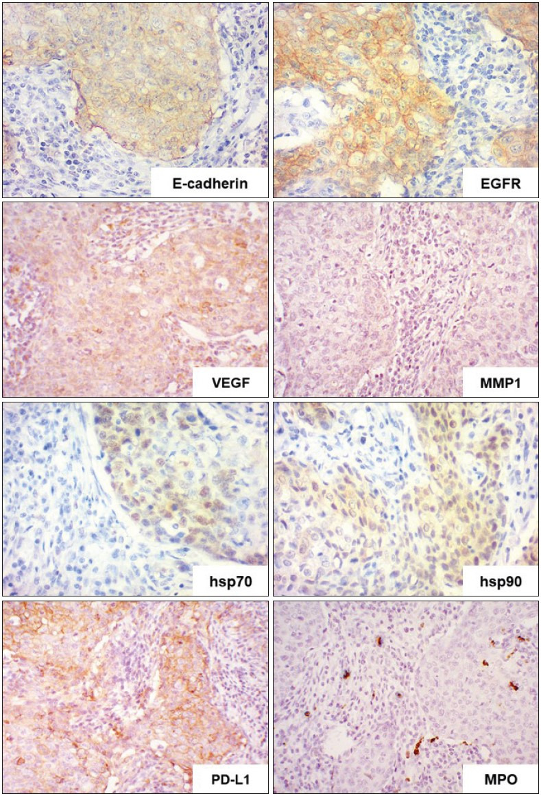 Invasive Breast Carcinoma of No Special Type with Medullary Pattern: Morphological and Immunohistochemical Features.