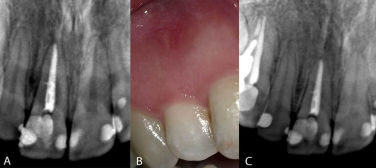 Conservative Treatment of an Infected Lateral Canal: A Case Report with a 4-Year Follow-up.