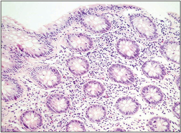 Analysis of Clinical and Histopathological Findings in Microscopic Colitis.