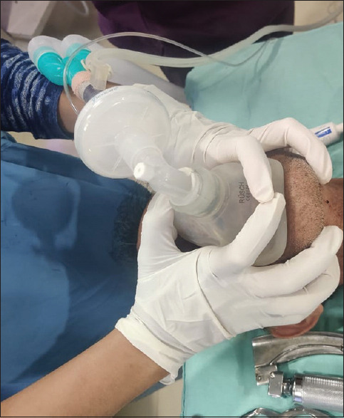 Comparison of the Effectiveness of Two-Handed Mask Ventilation Techniques (C-E versus V-E) in Obese Patients Requiring General Anesthesia in an Indian Population.