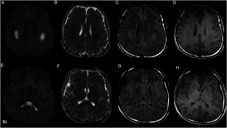 High-dose steroid-responsive COVID-19-related encephalopathy with a sudden onset of dysarthria mimicking stroke: a case report.