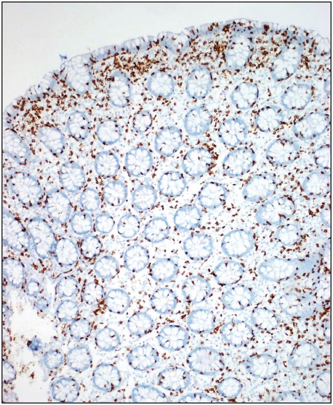 Analysis of Clinical and Histopathological Findings in Microscopic Colitis.