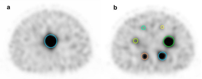 Development of a new quantification method using partial volume effect correction for individual energy peaks in <sup>111</sup>In-pentetreotide SPECT/CT.