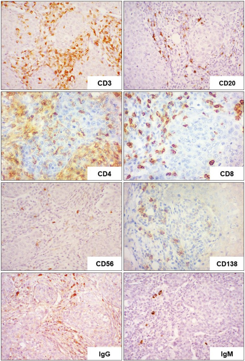 Invasive Breast Carcinoma of No Special Type with Medullary Pattern: Morphological and Immunohistochemical Features.