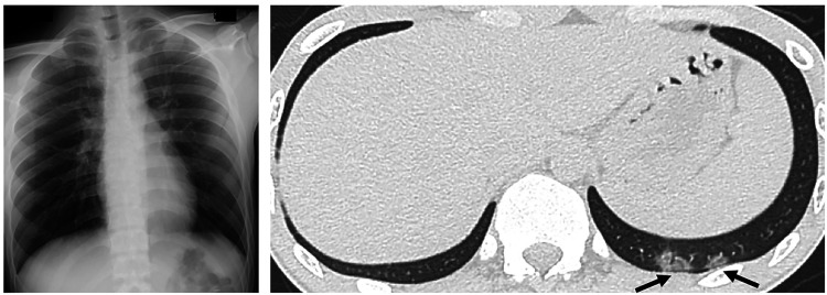 High-dose steroid-responsive COVID-19-related encephalopathy with a sudden onset of dysarthria mimicking stroke: a case report.