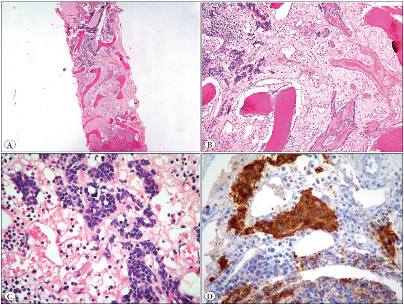 The Significance of Histopathologic Assessment in Bone Marrow Disease in Neuroblastoma.