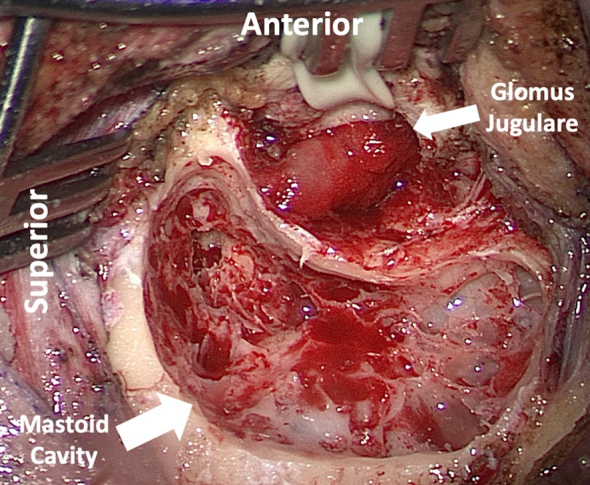 Paragangliomas of the head and neck: a contemporary review.