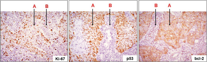 Invasive Breast Carcinoma of No Special Type with Medullary Pattern: Morphological and Immunohistochemical Features.