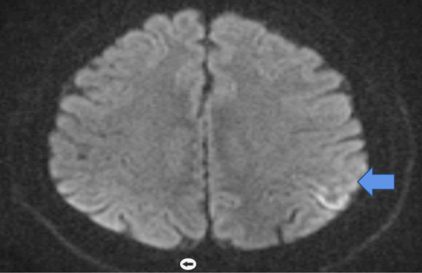 Creutzfeldt-Jakob Disease with Stroke-Like Symptoms: Case report.