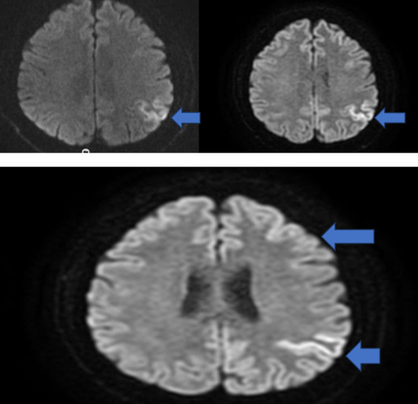 Creutzfeldt-Jakob Disease with Stroke-Like Symptoms: Case report.