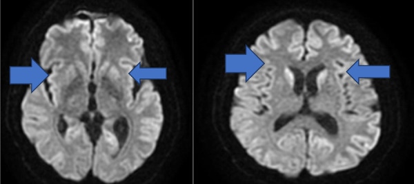 Creutzfeldt-Jakob Disease with Stroke-Like Symptoms: Case report.