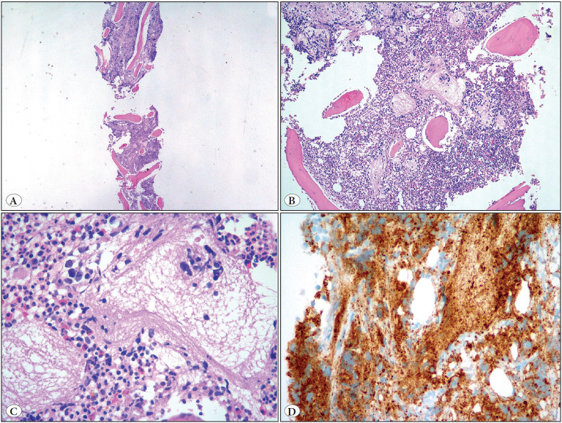 The Significance of Histopathologic Assessment in Bone Marrow Disease in Neuroblastoma.