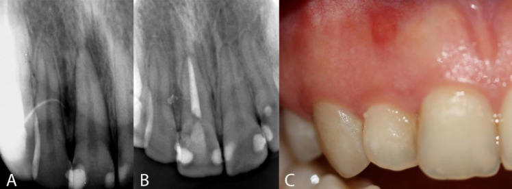 Conservative Treatment of an Infected Lateral Canal: A Case Report with a 4-Year Follow-up.