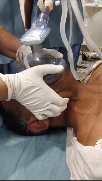 Comparison of the Effectiveness of Two-Handed Mask Ventilation Techniques (C-E versus V-E) in Obese Patients Requiring General Anesthesia in an Indian Population.