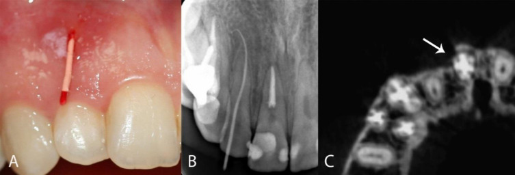 Conservative Treatment of an Infected Lateral Canal: A Case Report with a 4-Year Follow-up.