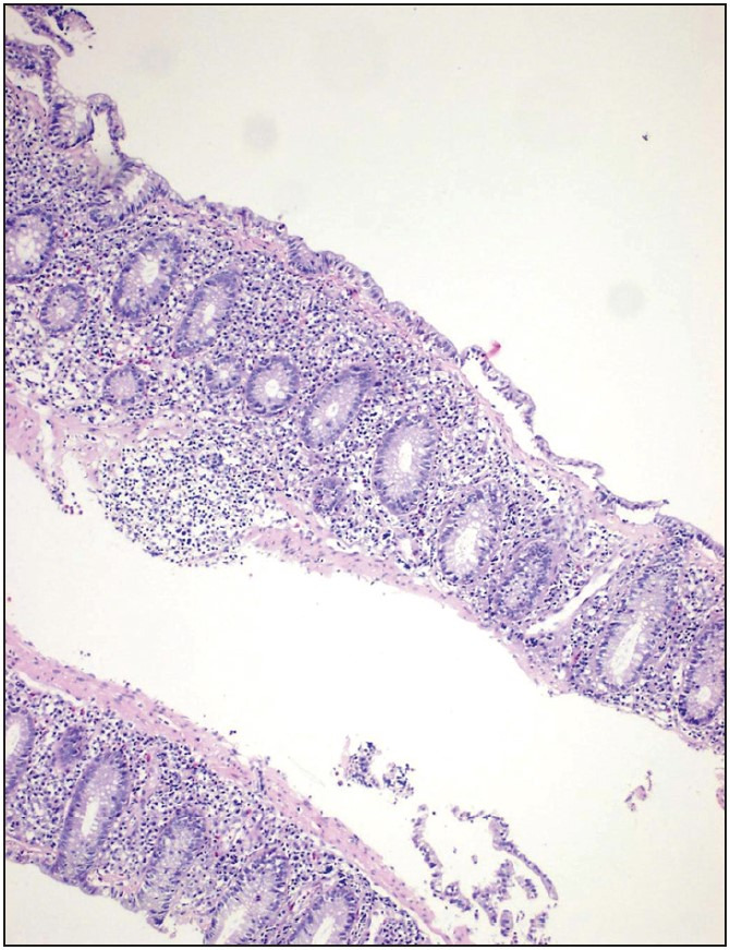 Analysis of Clinical and Histopathological Findings in Microscopic Colitis.