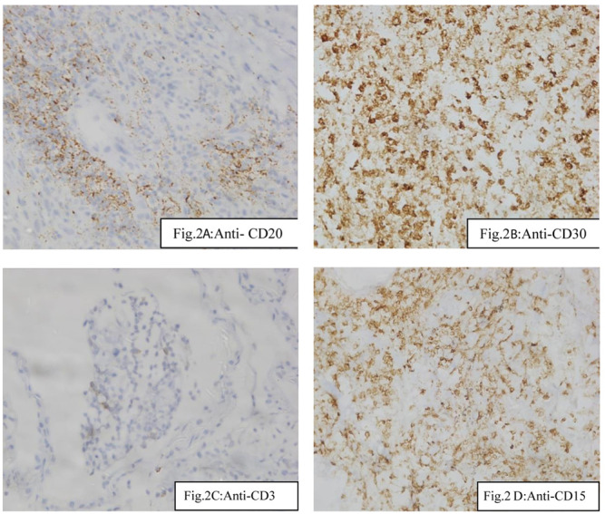 A rare case of pulmonary lymphomatoid granulomatosis complicated with venous thrombosis.