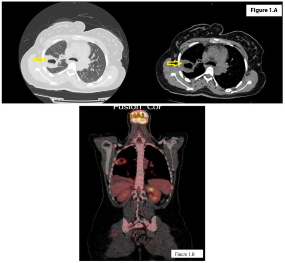 A rare case of pulmonary lymphomatoid granulomatosis complicated with venous thrombosis.