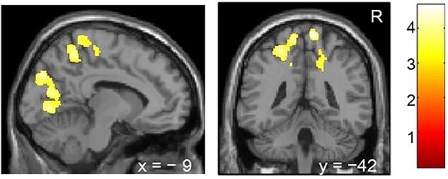 Academic achievements and brain volume development in children and adolescents.