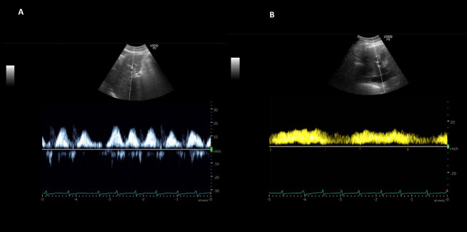 Point of Care Ultrasonography to Monitor Decongestive Therapy in Heart Failure: Seeing is Believing.