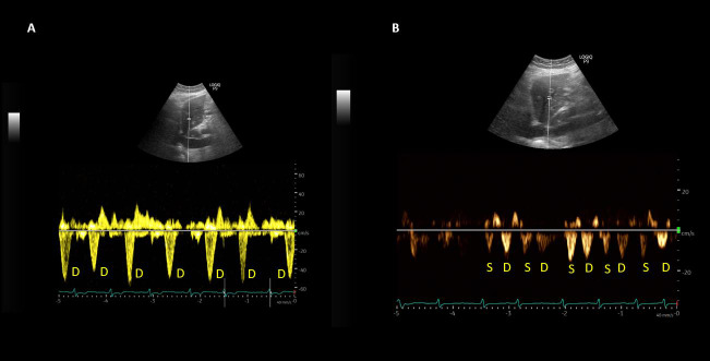 Point of Care Ultrasonography to Monitor Decongestive Therapy in Heart Failure: Seeing is Believing.