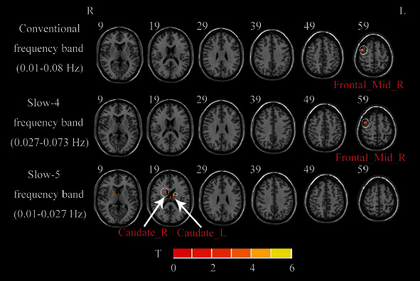 Frequency-Specific Changes of Amplitude of Low-Frequency Fluctuations in Patients with Acute Basal Ganglia Ischemic Stroke.