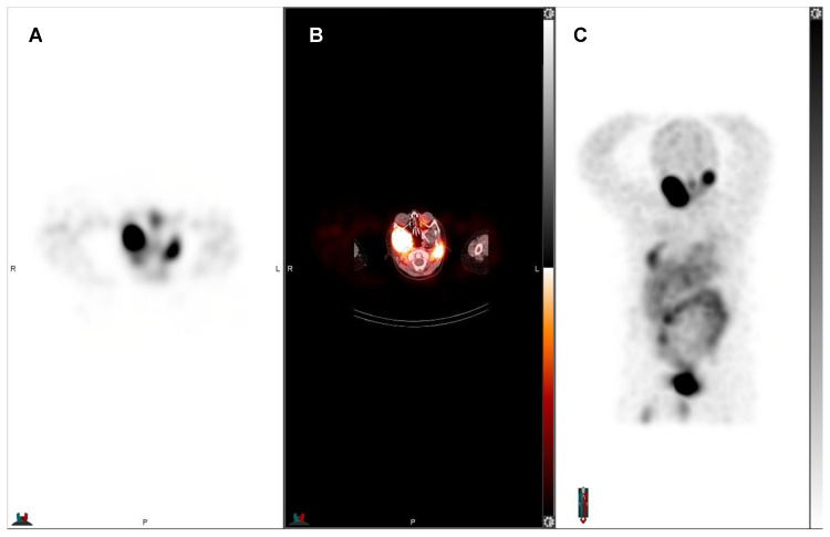 Radiotheranostics - Precision Medicine in Nuclear Medicine and Molecular Imaging.