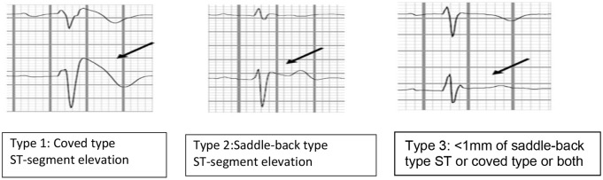 Brugada syndrome: should we be screening patients before prescribing psychotropic medication?