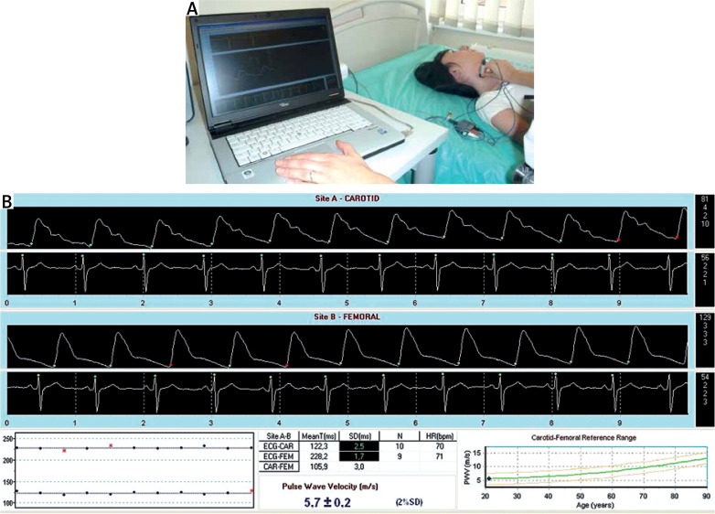 Arterial stiffness and atherosclerosis in systemic lupus erythematosus patients.