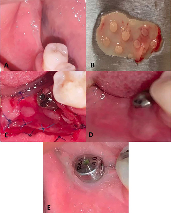 Onlay platelet-rich fibrin membrane versus free gingival graft in increasing the width of keratinized mucosa around dental implants: A split-mouth randomized clinical study.