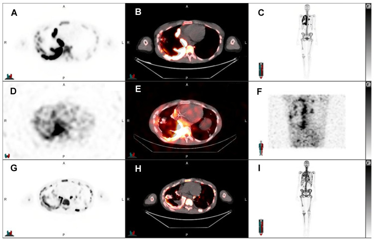 Radiotheranostics - Precision Medicine in Nuclear Medicine and Molecular Imaging.