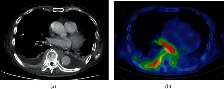 Successful Treatment of Concomitant Pleural Mucosa-Associated Lymphoid Tissue Lymphoma and Monoclonal Gammopathy of Undetermined Significance with Lenalidomide, Rituximab, and Dexamethasone.