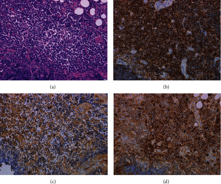 Successful Treatment of Concomitant Pleural Mucosa-Associated Lymphoid Tissue Lymphoma and Monoclonal Gammopathy of Undetermined Significance with Lenalidomide, Rituximab, and Dexamethasone.