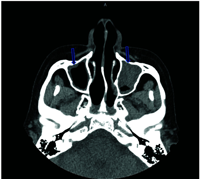 Necrotizing scleritis as the initial presentation of granulomatosis with polyangiitis.