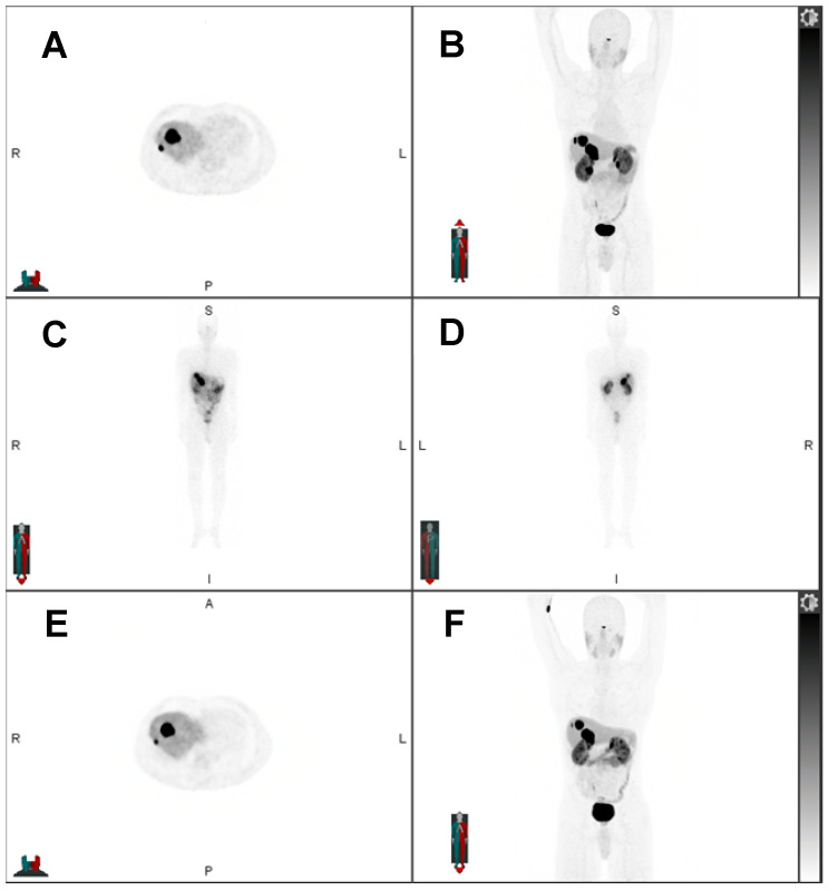 Radiotheranostics - Precision Medicine in Nuclear Medicine and Molecular Imaging.